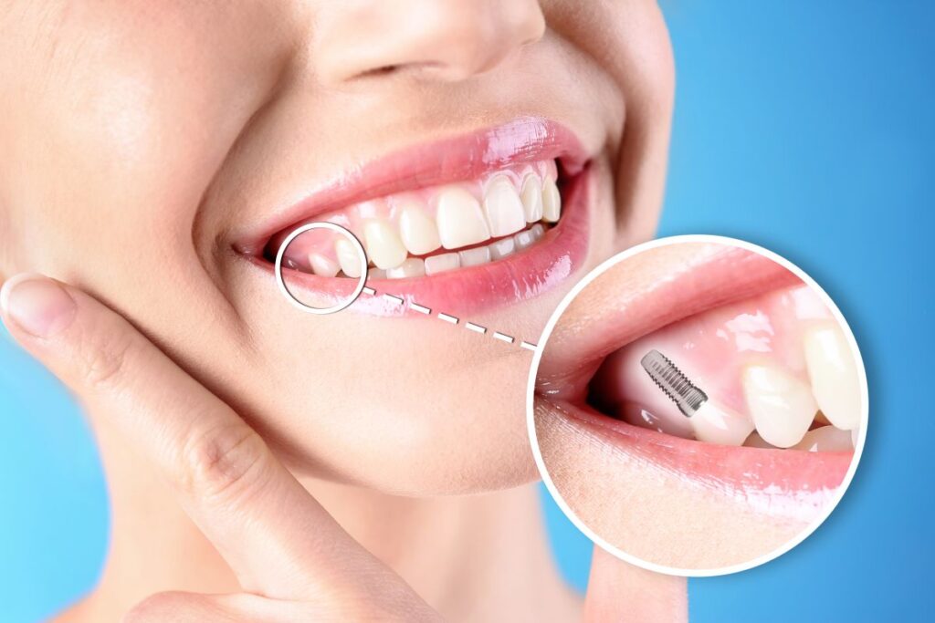 Reliable dental implants near you for lasting tooth replacement.