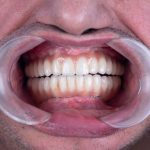 the benefits of full mouth dental implants restoring your smile and confidence